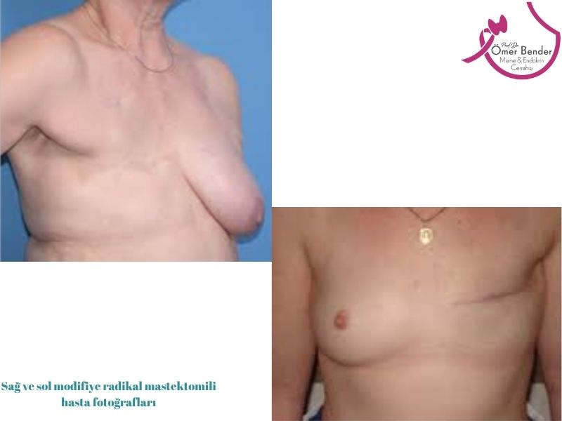 modifiye-radikal-mastektomi-nedir