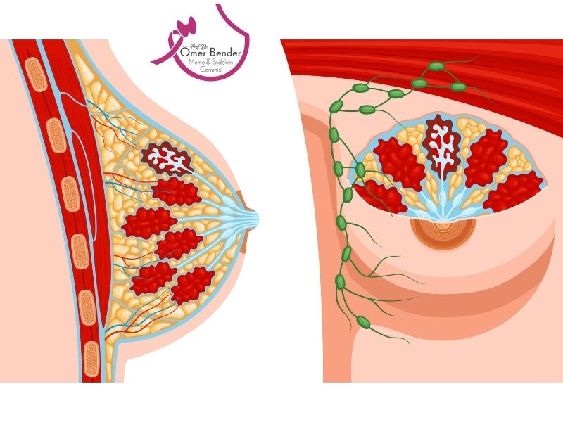 İntraduktal Papillom Tanısı Nasıl Yapılmaktadır