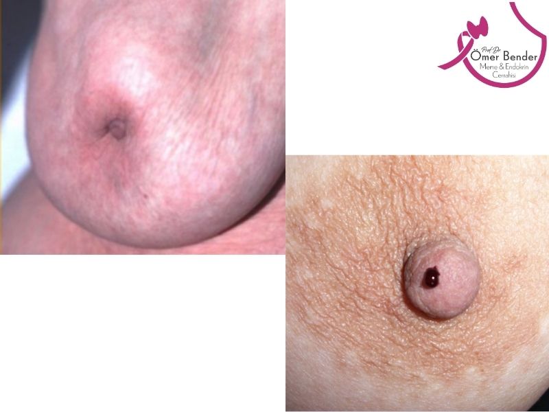 meme-basinda-ice-cekilme-veya-sekil-bozuklugu