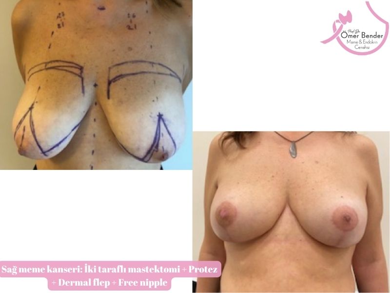 sag-meme-kanseri-iki-tarafli-mastektomi-protez-dermal-flep-free-nipple