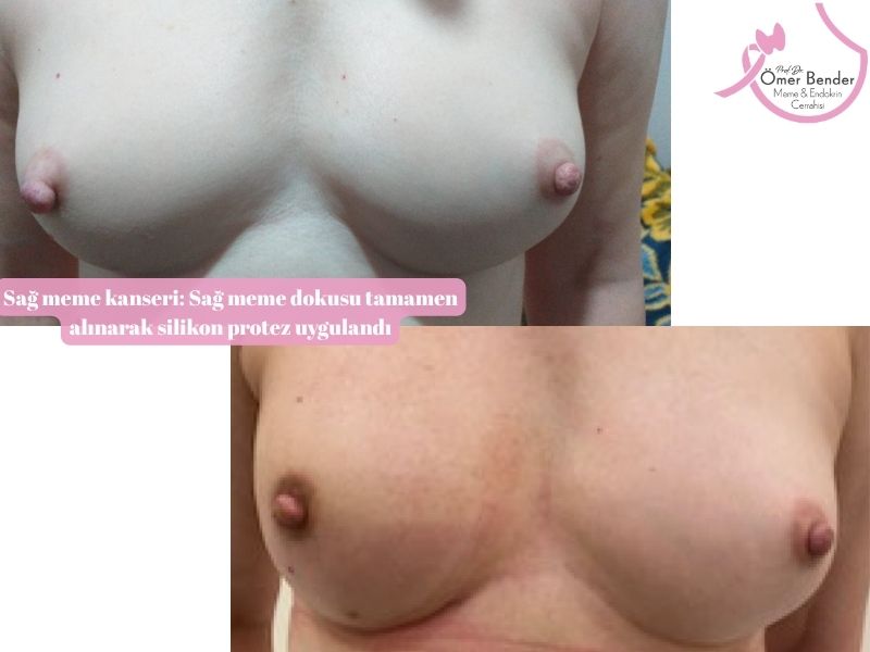 sag-meme-kanseri-sag-meme-dokusu-tamamen-alinarak-silikon-protez-uygulandi