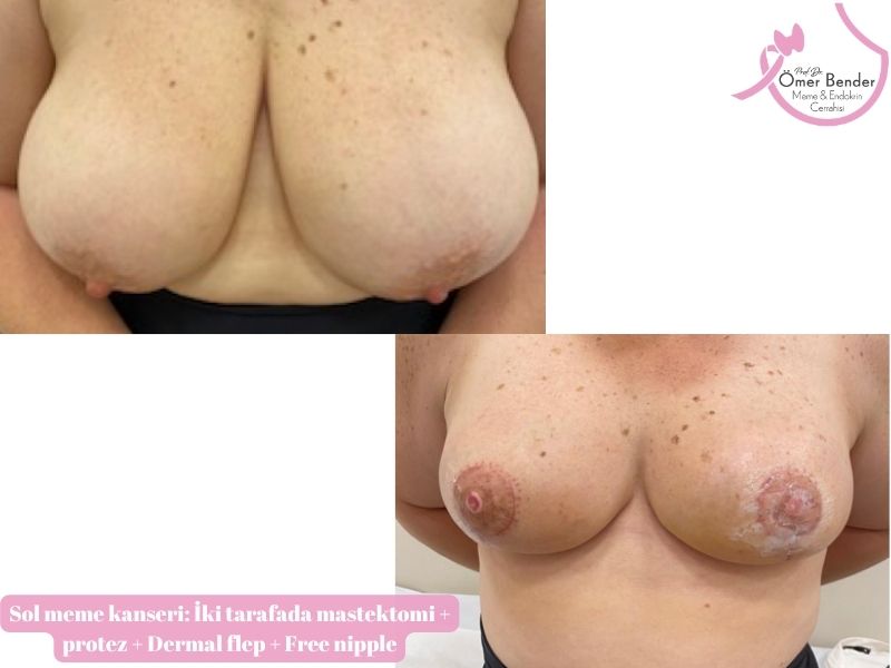 sol-meme-kanseri-iki-tarafada-mastektomi-protez-dermal-flep-free-nipple