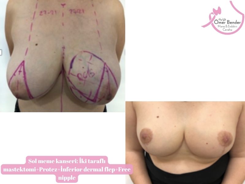 sol-meme-kanseri-iki-tarafli-mastektomiprotezinferior-dermal-flepfree-nipple
