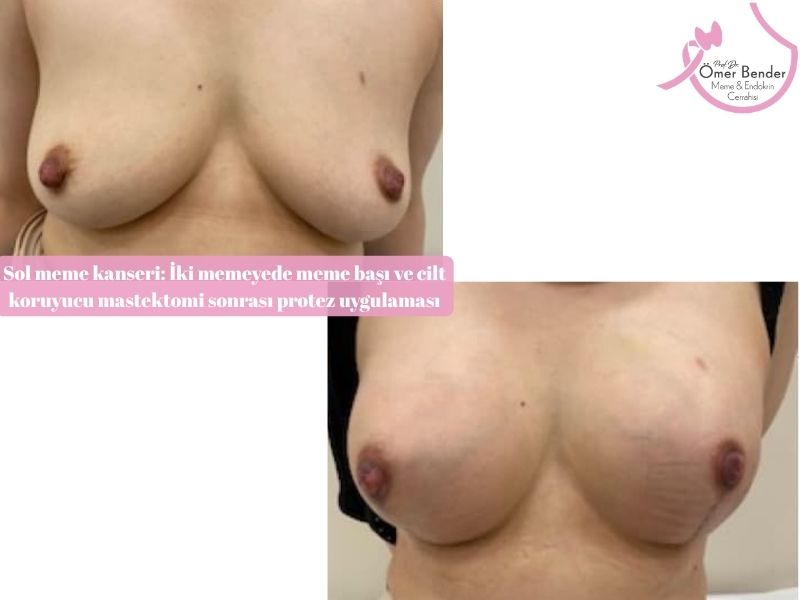 sol-meme-kanseri-mastektomi-sonrasi-protez-uygulamasi