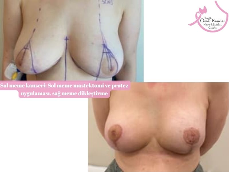 sol-meme-kanseri-sol-meme-mastektomi-ve-protez-uygulamasi-sag-meme-diklestirme